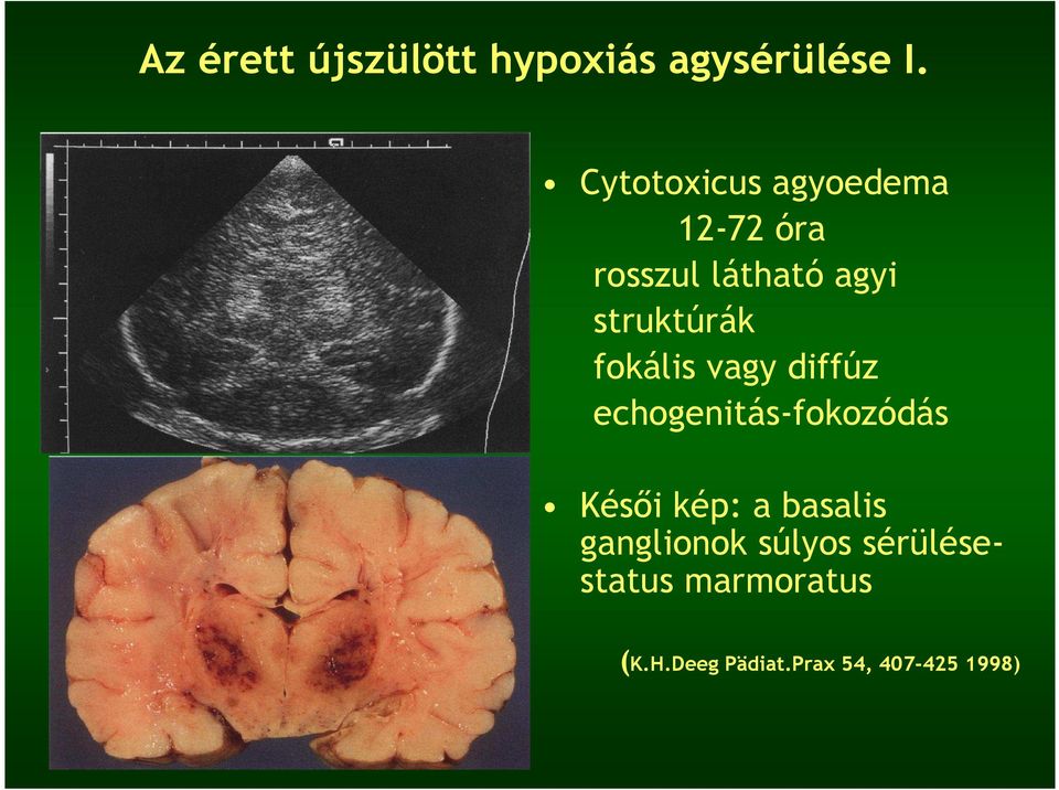 fokális vagy diffúz echogenitás-fokozódás Késıi kép: a basalis