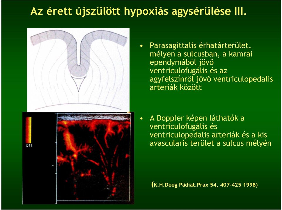 ventriculofugális és az agyfelszínrıl jövı ventriculopedalis arteriák között A Doppler