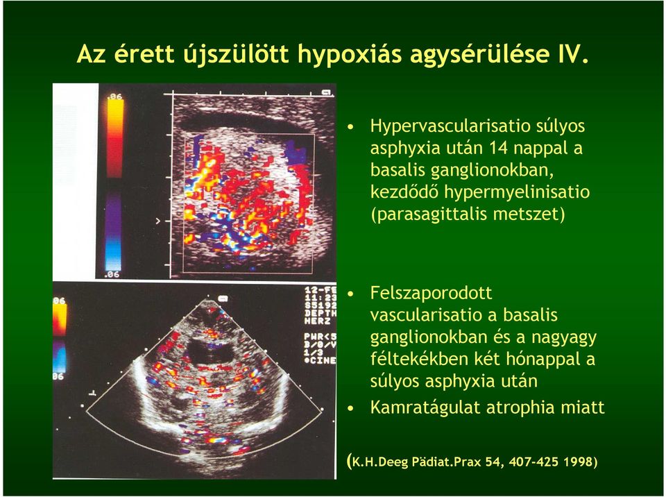 hypermyelinisatio (parasagittalis metszet) Felszaporodott vascularisatio a basalis