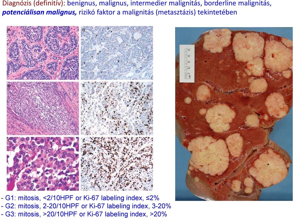 tekintetében - G1: mitosis, <2/10HPF or Ki-67 labeling index, 2% - G2: mitosis,