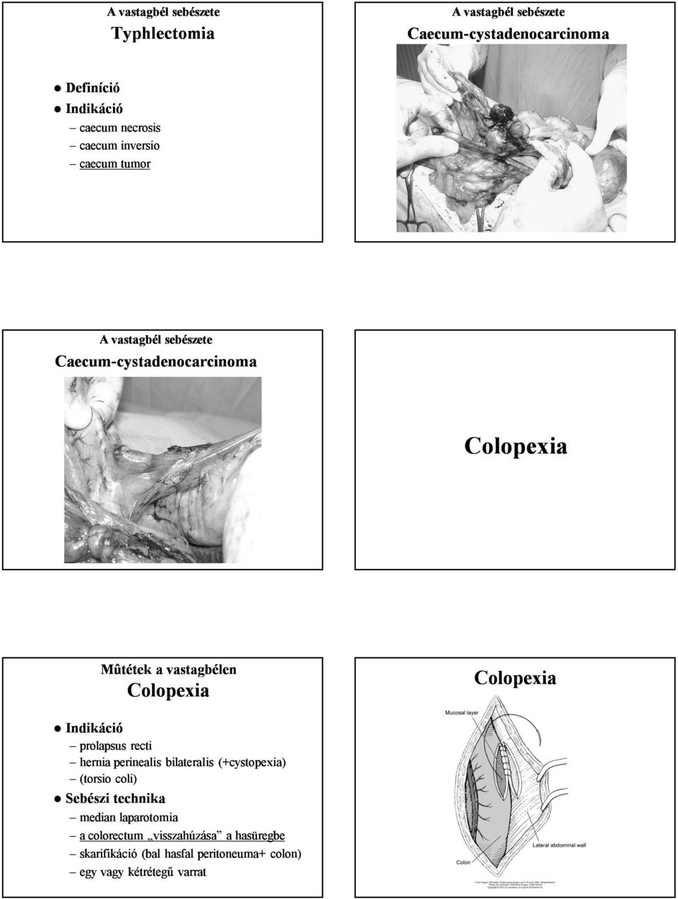 prolapsus recti hernia perinealis bilateralis (+cystopexia) (torsio coli) Sebészi technika median