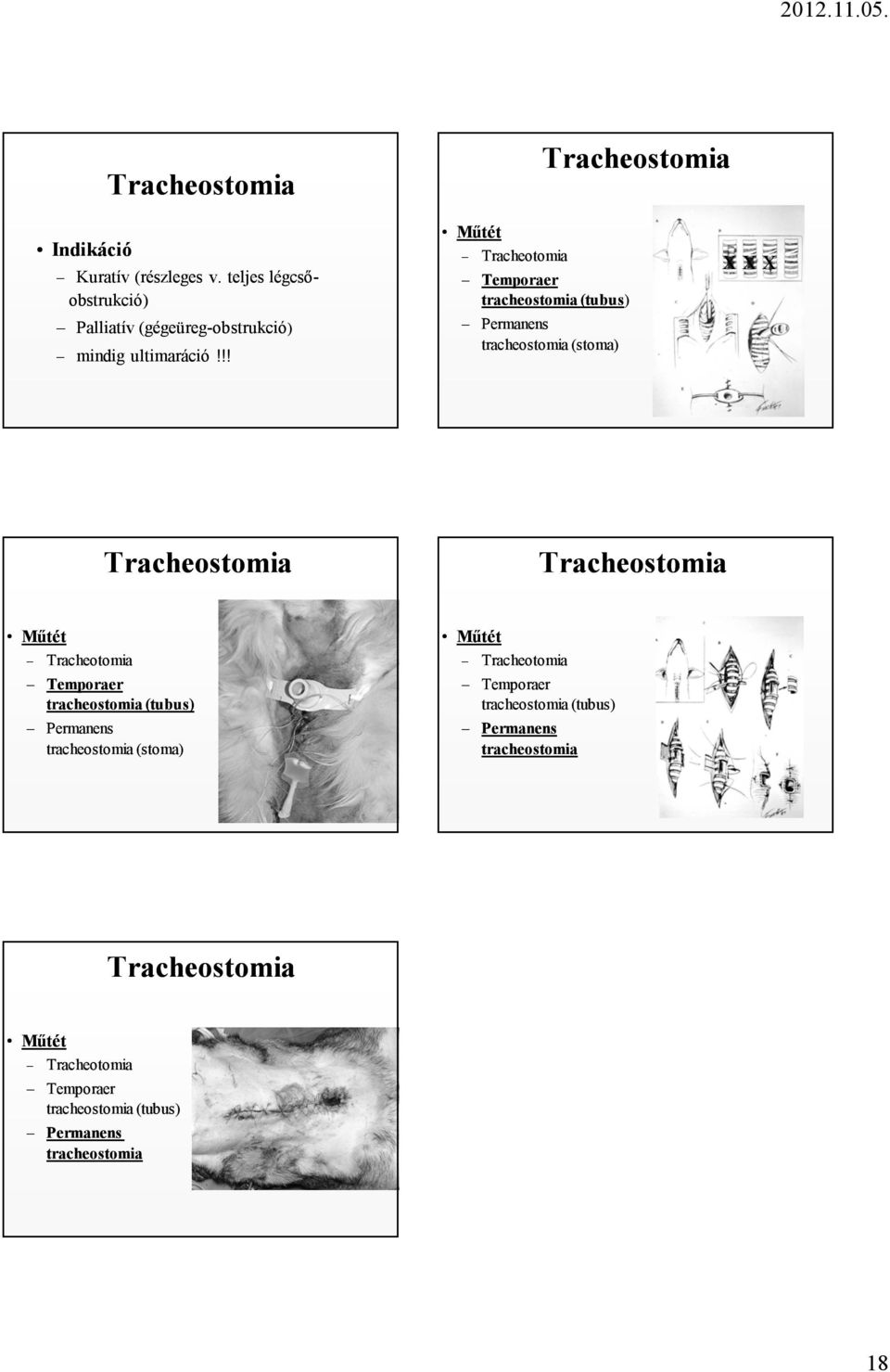 !! Tracheotomia Temporaer tracheostomia (tubus) Permanens tracheostomia (stoma) X X X Tracheostomia Tracheostomia