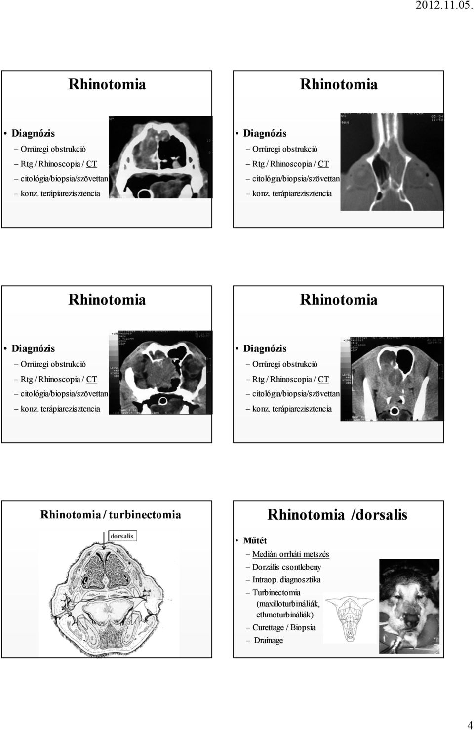Dorzális csontlebeny Intraop. diagnosztika Turbinectomia (maxilloturbináliák, ethmoturbináliák) Curettage / Biopsia 4