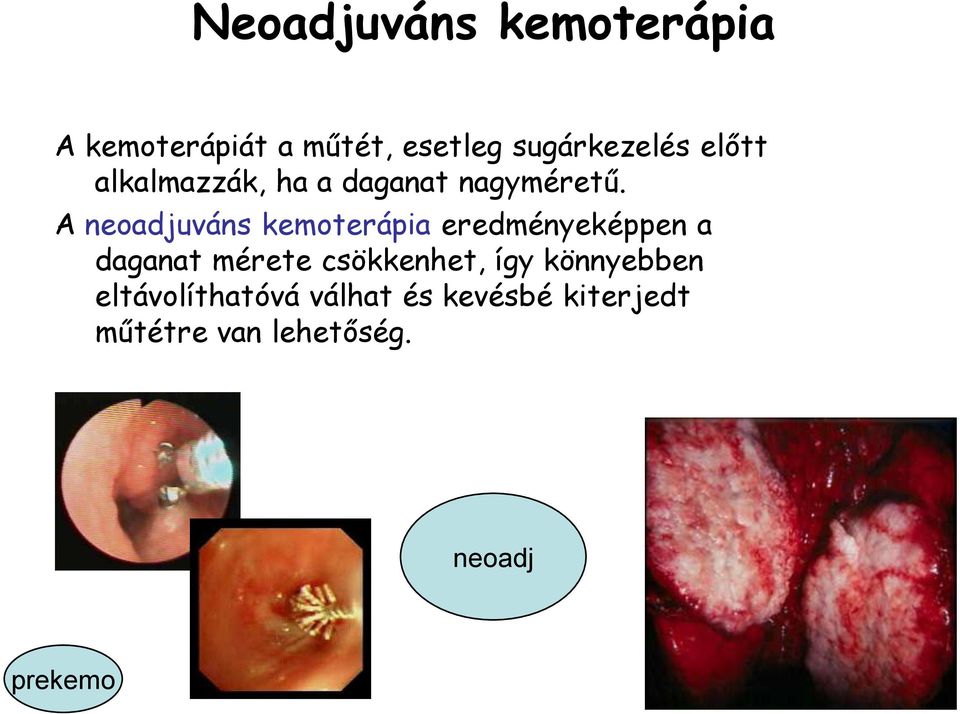 A neoadjuváns kemoterápia eredményeképpen a daganat mérete