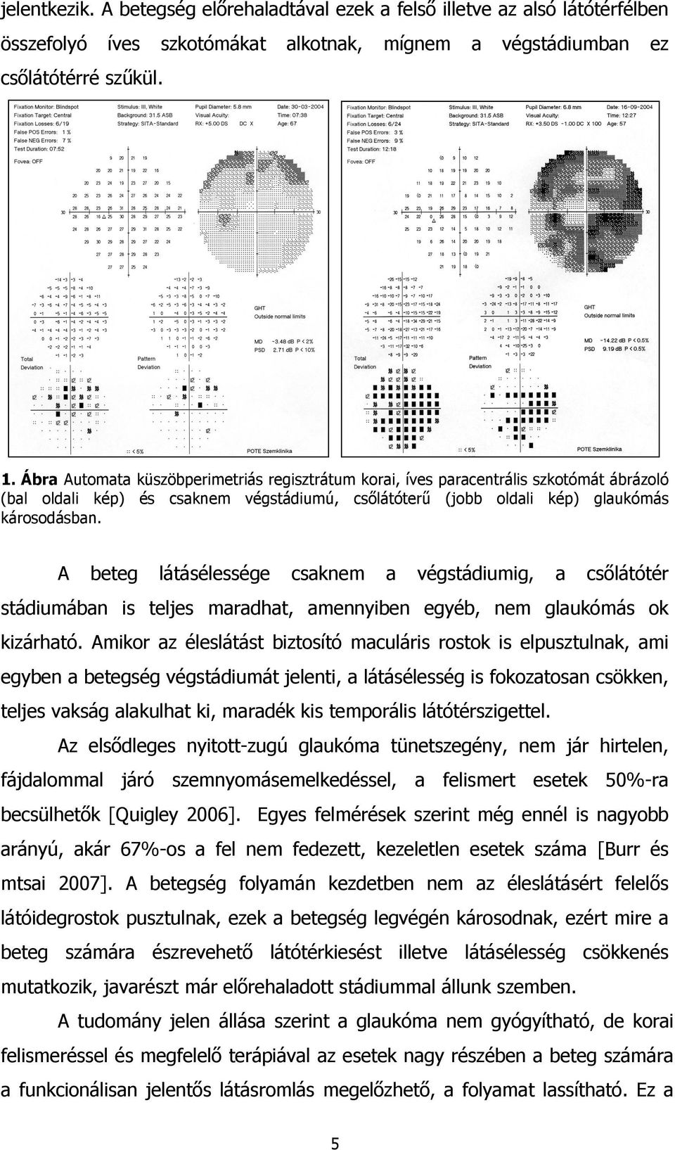 A beteg látásélessége csaknem a végstádiumig, a csőlátótér stádiumában is teljes maradhat, amennyiben egyéb, nem glaukómás ok kizárható.