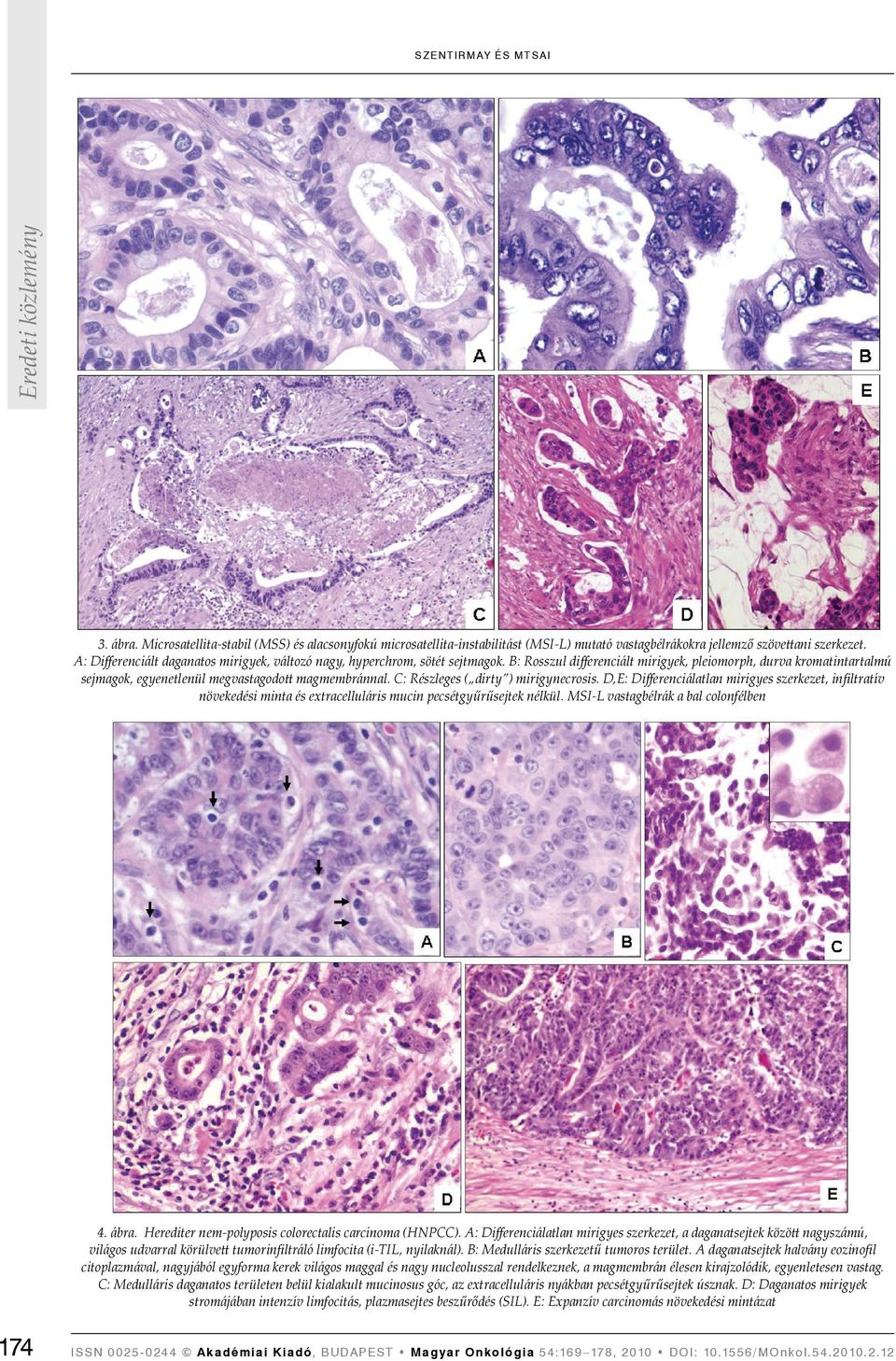 C: Részleges ( dirty ) mirigynecrosis. D,E: Diﬀerenciálatlan mirigyes szerkezet, infiltratív növekedési minta és extracelluláris mucin pecsétgyűrűsejtek nélkül. MSI-L vastagbélrák a bal colonfélben 4.