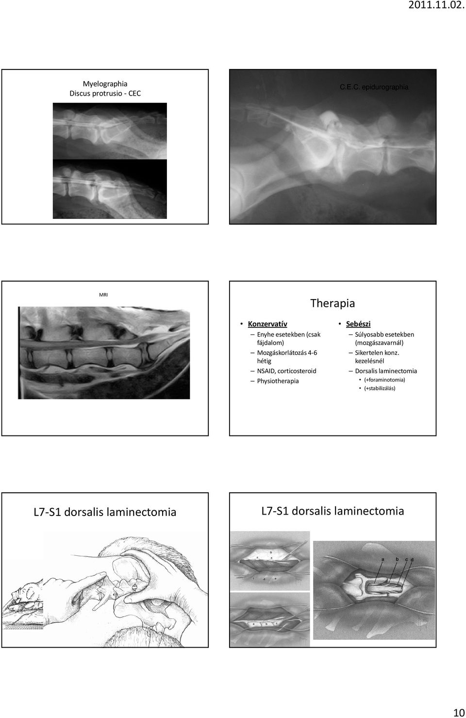 Mozgáskorlátozás 4-6 hétig NSAID, corticosteroid Physiotherapia L7-S1 dorsalis laminectomia