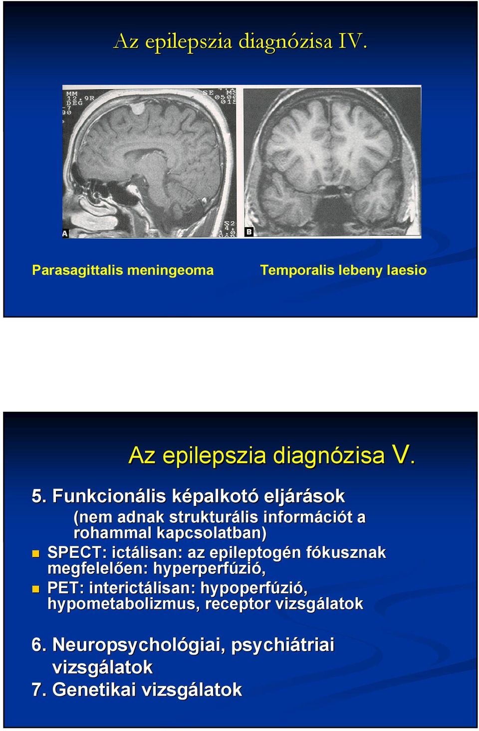 ictálisan lisan: : az epileptogén fókusznak megfelelően: en: hyperperfúzi zió, PET: interictálisan lisan: