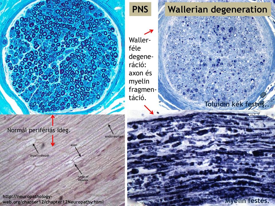 Wallerféle degeneráció: axon és myelin