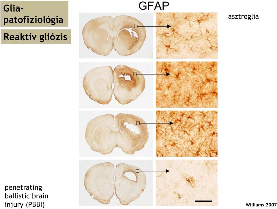 asztroglia penetrating