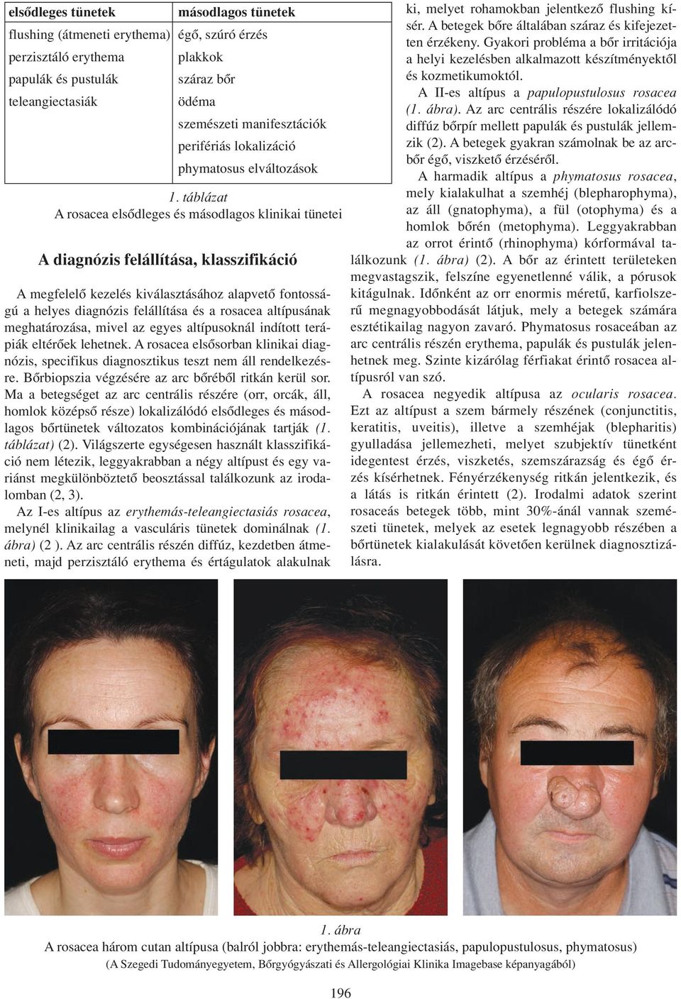 táblázat A rosacea elsôdleges és másodlagos klinikai tünetei A diagnózis felállítása, klasszifikáció A megfelelô kezelés kiválasztásához alapvetô fontosságú a helyes diagnózis felállítása és a