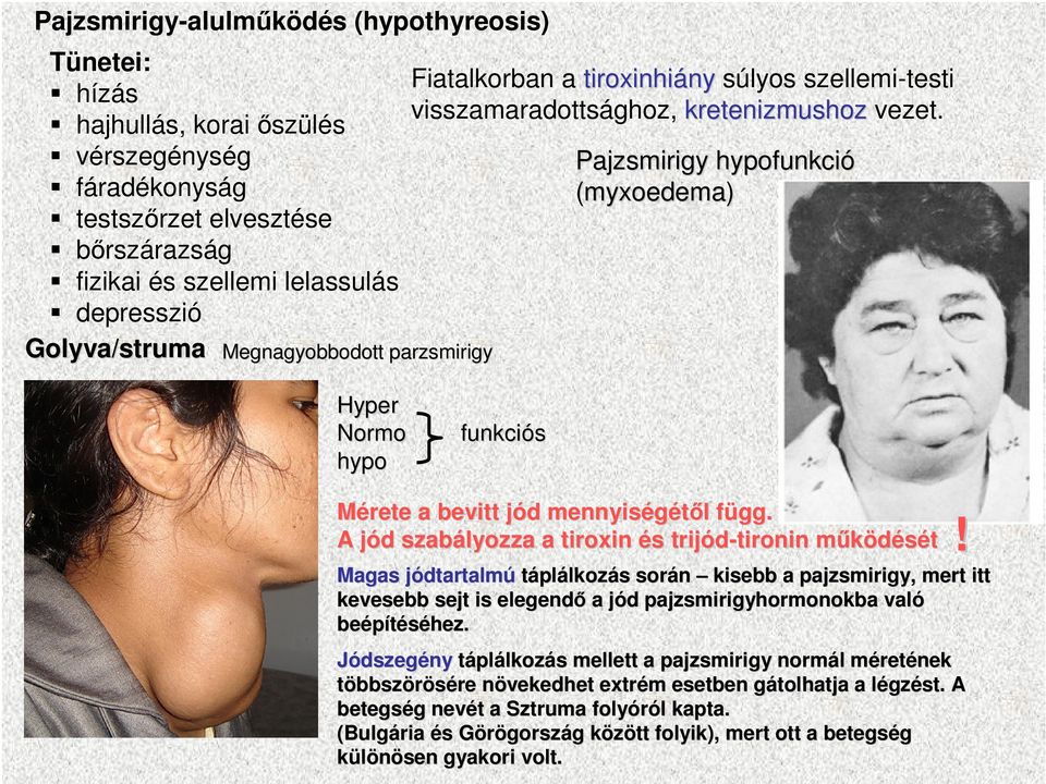 Pajzsmirigy hypofunkció (myxoedema) Hyper Normo hypo funkciós Mérete a bevitt jód j d mennyiségétıl l függ.