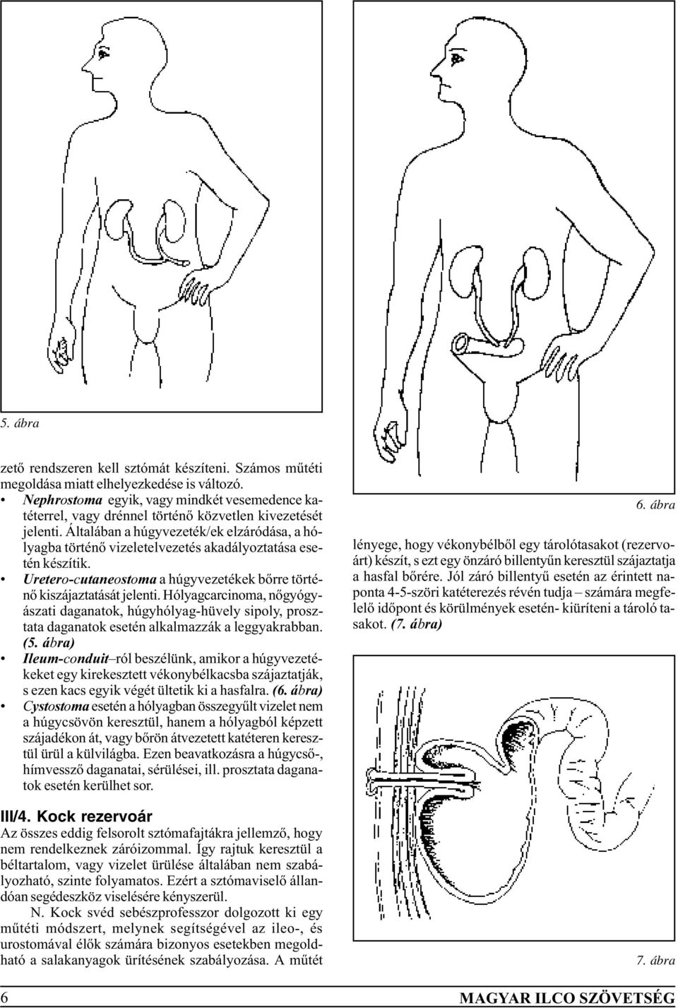 Általában a húgyvezeték/ek elzáródása, a hólyagba történõ vizeletelvezetés akadályoztatása esetén készítik. Uretero-cutaneostoma a húgyvezetékek bõrre történõ kiszájaztatását jelenti.