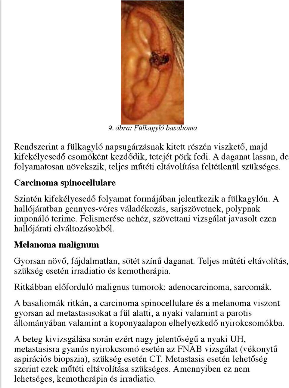 A hallójáratban gennyes-véres váladékozás, sarjszövetnek, polypnak imponáló terime. Felismerése nehéz, szövettani vizsgálat javasolt ezen hallójárati elváltozásokból.