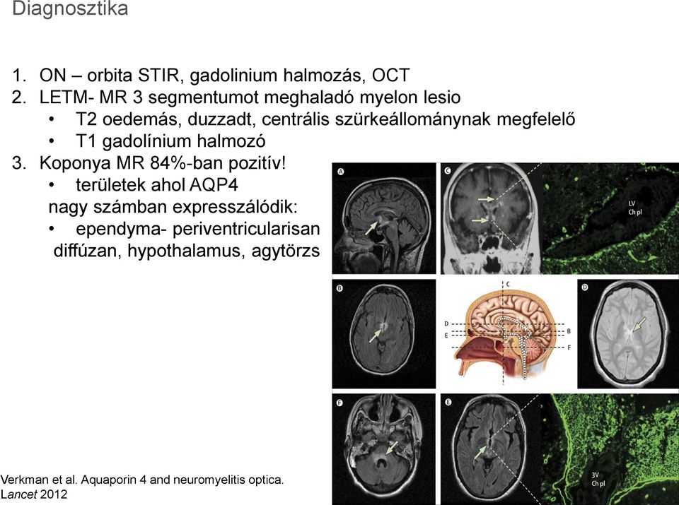 megfelelő T1 gadolínium halmozó 3. Koponya MR 84%-ban pozitív!