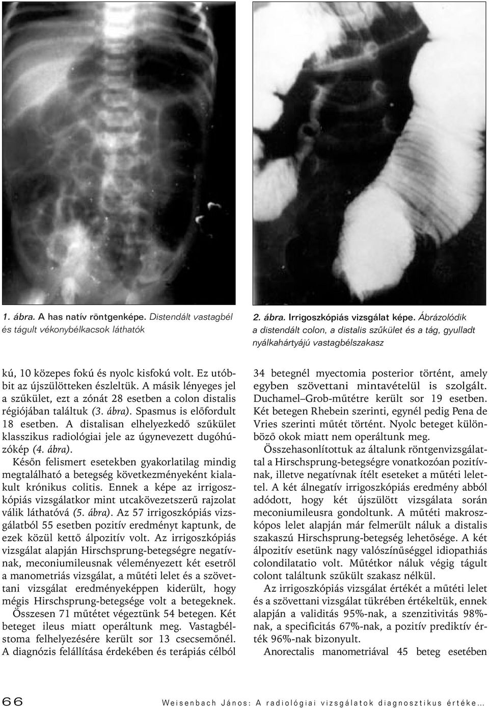 A másik lényeges jel a szûkület, ezt a zónát 28 esetben a colon distalis régiójában találtuk (3. ábra). Spasmus is elôfordult 18 esetben.