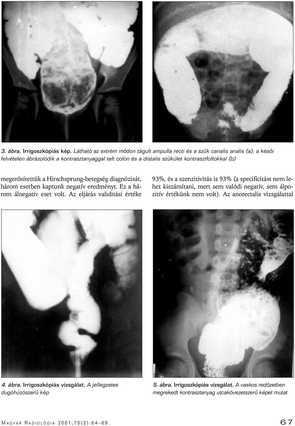 megerôsítettük a Hirschsprung-betegség diagnózisát, három esetben kaptunk negatív eredményt. Ez a három álnegatív eset volt.