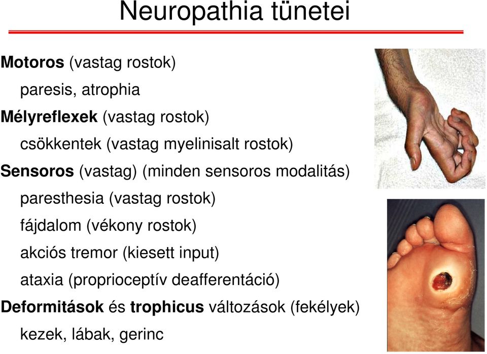 paresthesia (vastag rostok) fájdalom (vékony rostok) akciós tremor (kiesett input) ataxia