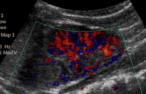 Nephroblastomatosis UH jellemzők: kerek