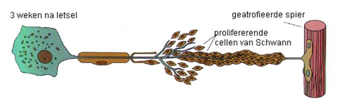 Wallerian degeneration PNS 2.