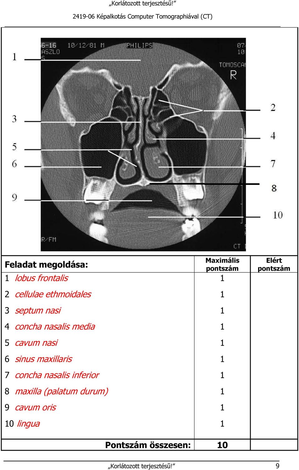 cavum nasi 6 sinus maxillaris 7 concha nasalis inferior 8 maxilla (palatum