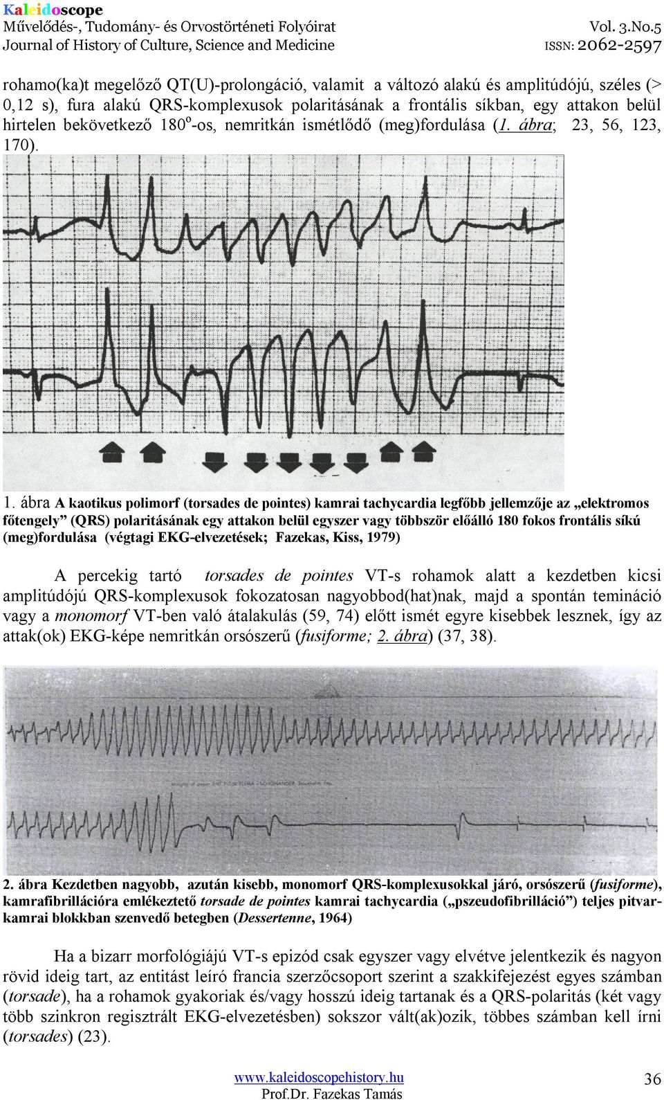 3, 170). 1. ábra A kaotikus polimorf (torsades de pointes) kamrai tachycardia legfőbb jellemzője az elektromos főtengely (QRS) polaritásának egy attakon belül egyszer vagy többször előálló 180 fokos