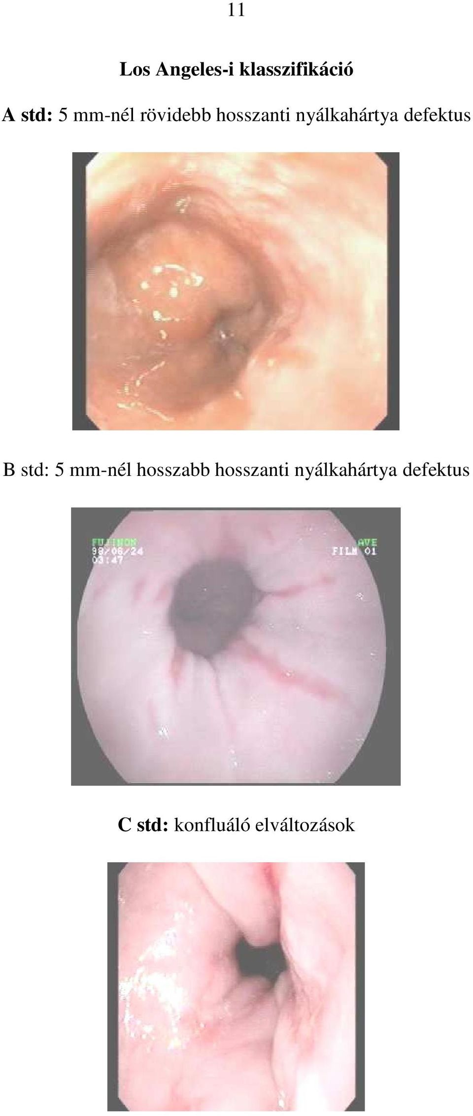 defektus B std: 5 mm-nél hosszabb hosszanti