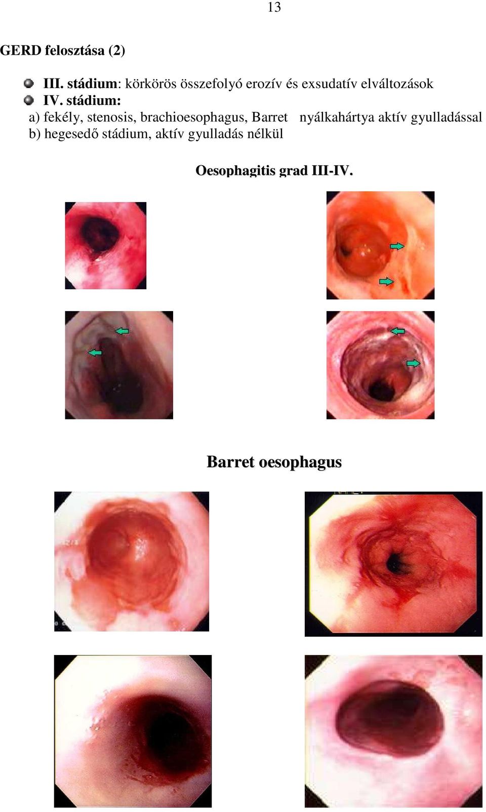 stádium: a) fekély, stenosis, brachioesophagus, Barret