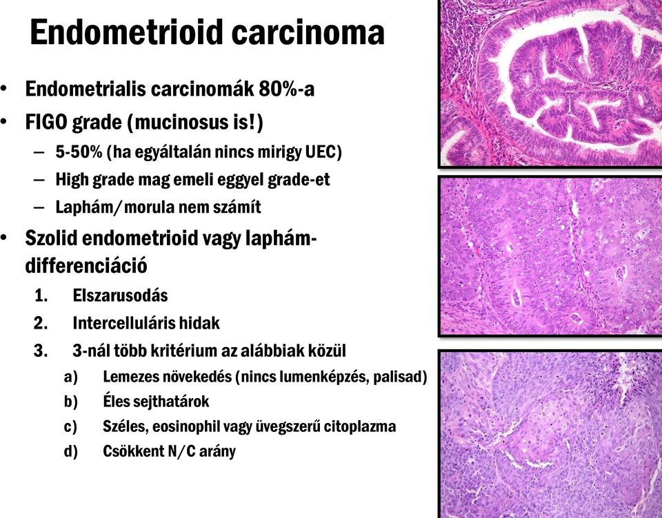 endometrioid vagy laphámdifferenciáció 1. Elszarusodás 2. Intercelluláris hidak 3.