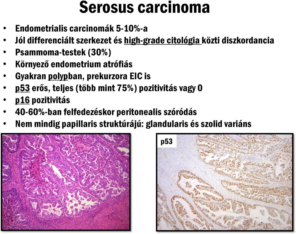 polypban, prekurzora EIC is p53 erős, teljes (több mint 75%) pozitivitás vagy 0 p16 pozitivitás