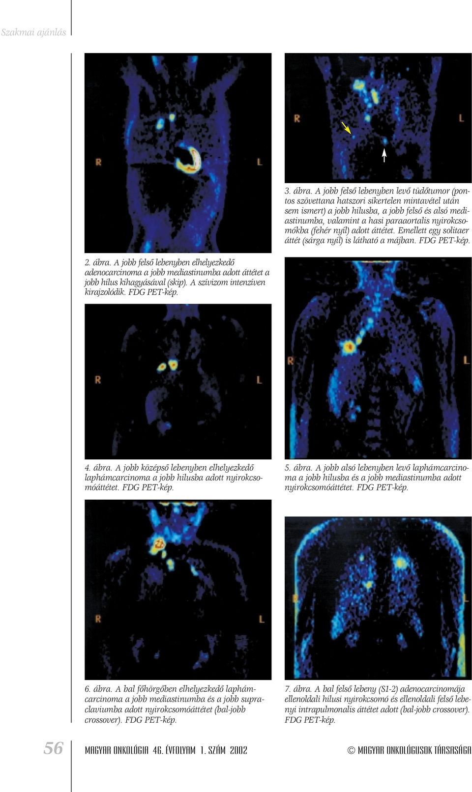 nyirokcsomókba (fehér nyíl) adott áttétet. Emellett egy solitaer áttét (sárga nyíl) is látható a májban. FDG PET-kép. 2. ábra.