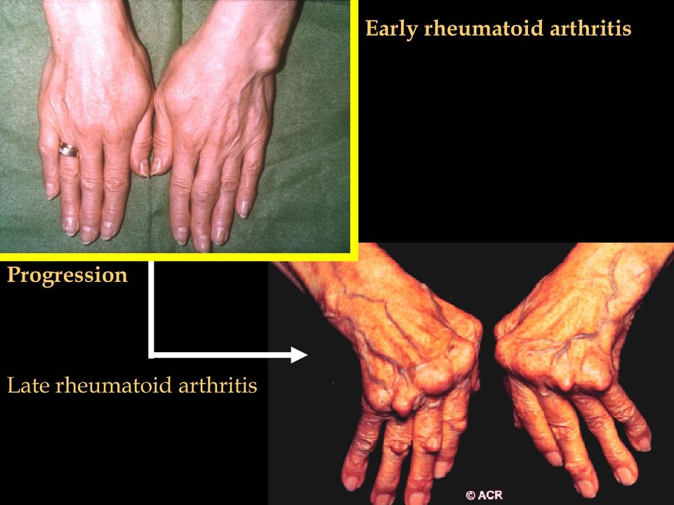 arthritis