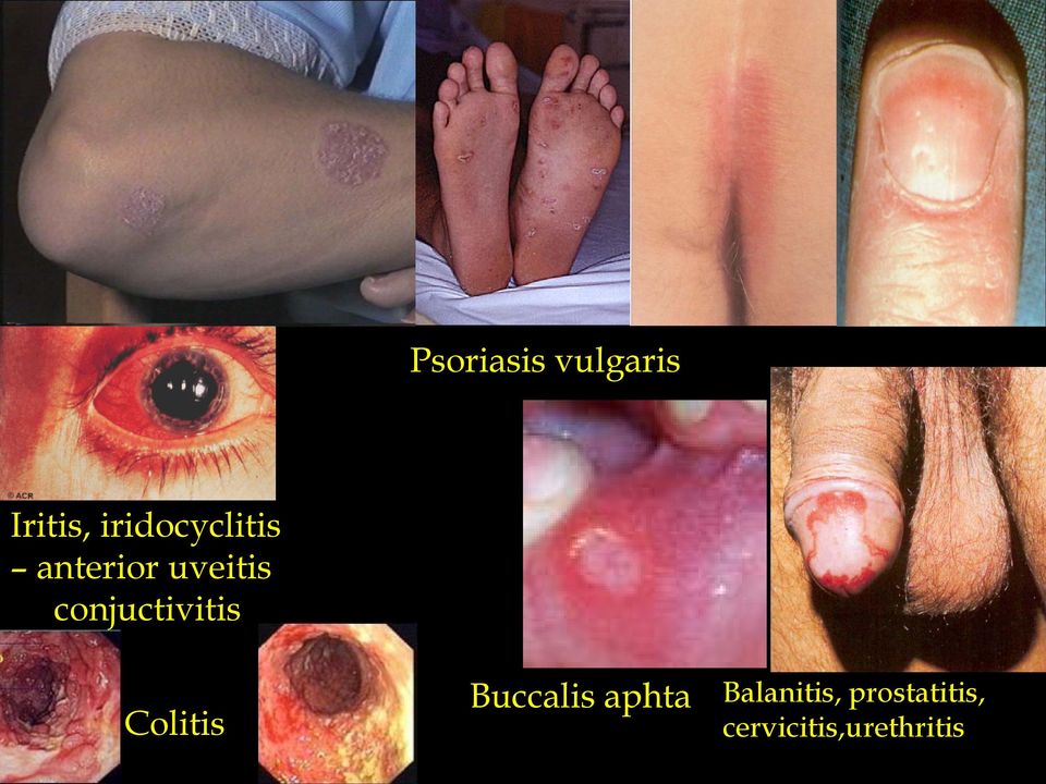 conjuctivitis Colitis Buccalis