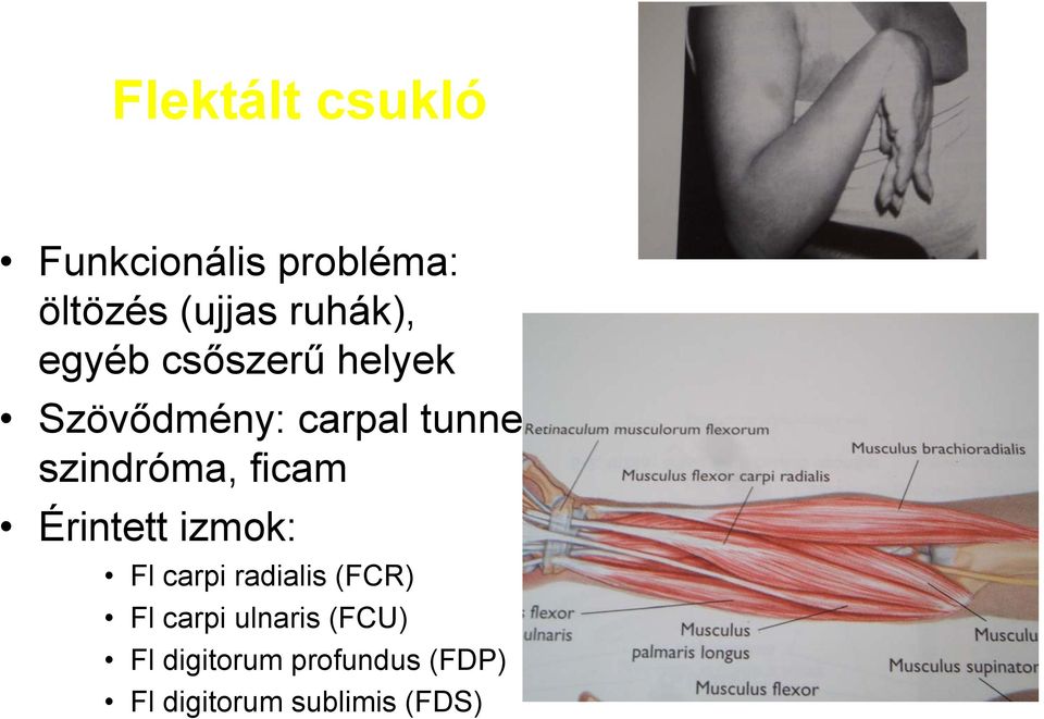 ficam Érintett izmok: Fl carpi radialis (FCR) Fl carpi