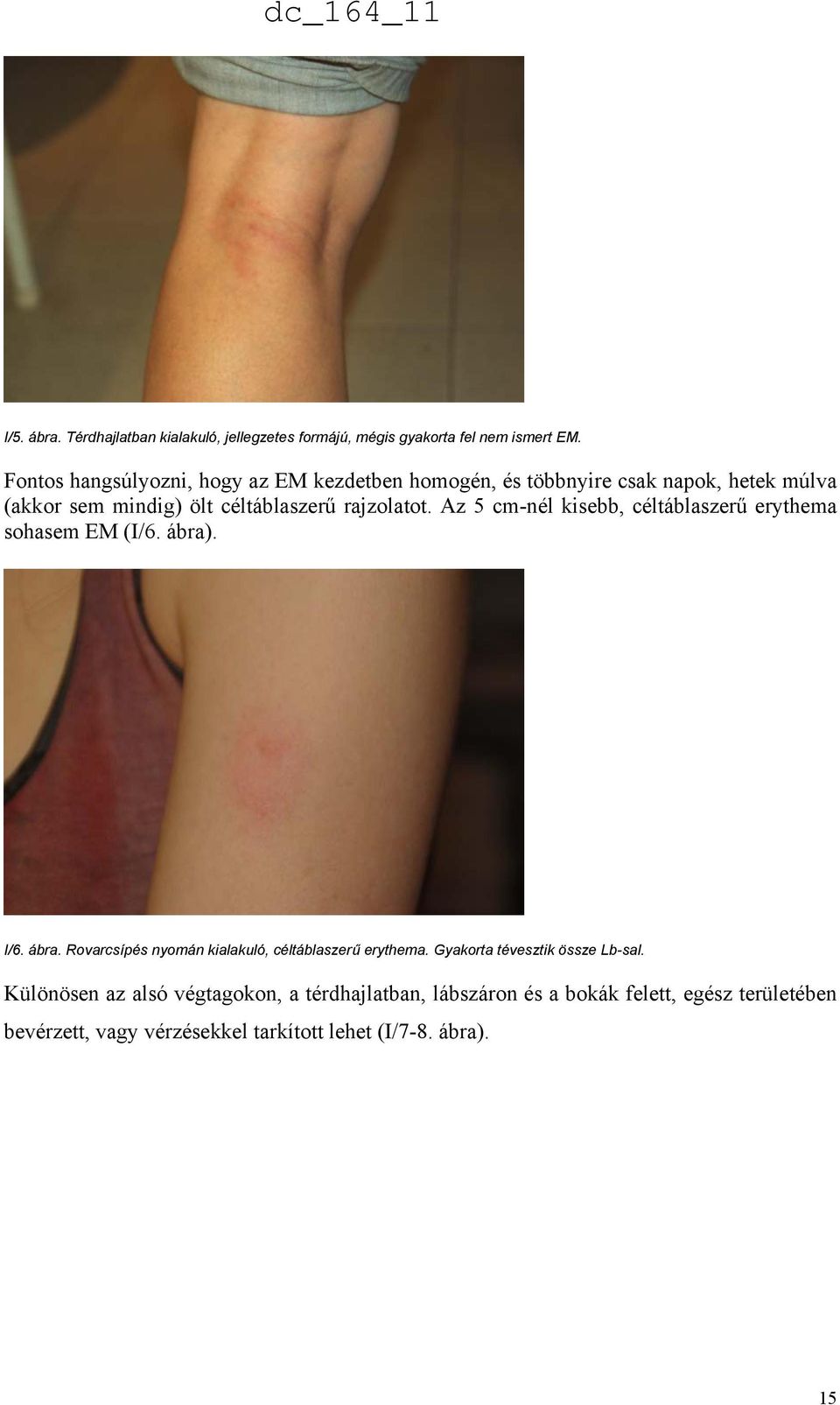 Az 5 cm-nél kisebb, céltáblaszerű erythema sohasem EM (I/6. ábra). I/6. ábra. Rovarcsípés nyomán kialakuló, céltáblaszerű erythema.