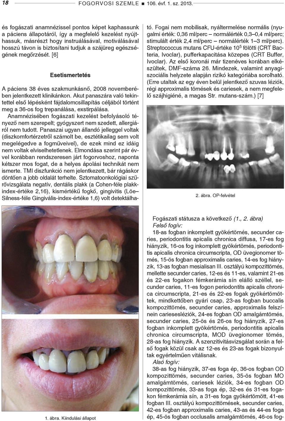 szájüreg egészségének megőrzését. [6] Esetismertetés A páciens 38 éves szakmunkásnő, 2008 novemberében jelentkezett klinikánkon.