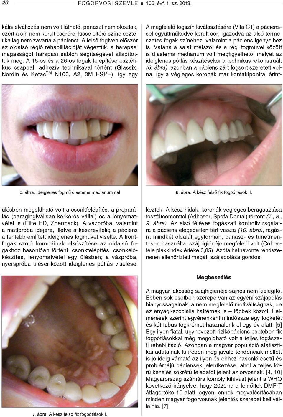 A 16-os és a 26-os fogak felépítése esztétikus csappal, adhezív technikával történt (Glassix, Nordin és Ketac TM N100, A2, 3M ESPE), így egy 6. ábra. Ideiglenes fogmű diastema medianummal 8. ábra. A kész felső fix fogpótlások II.