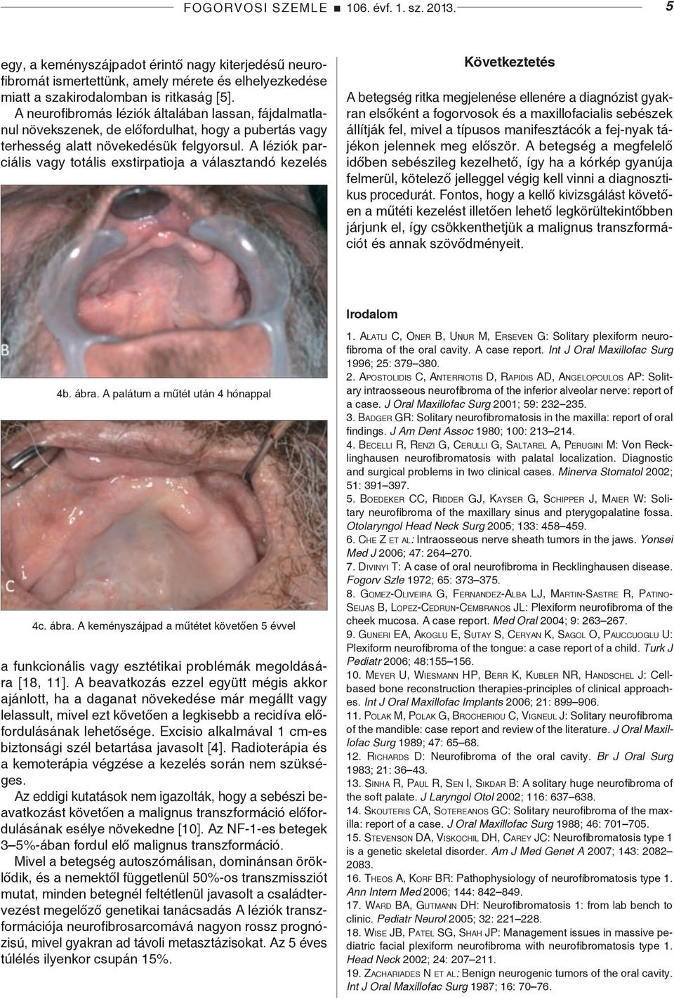 A léziók parciális vagy totális exstirpatioja a választandó kezelés Következtetés A betegség ritka megjelenése ellenére a diagnózist gyakran elsőként a fogorvosok és a maxillofacialis sebészek