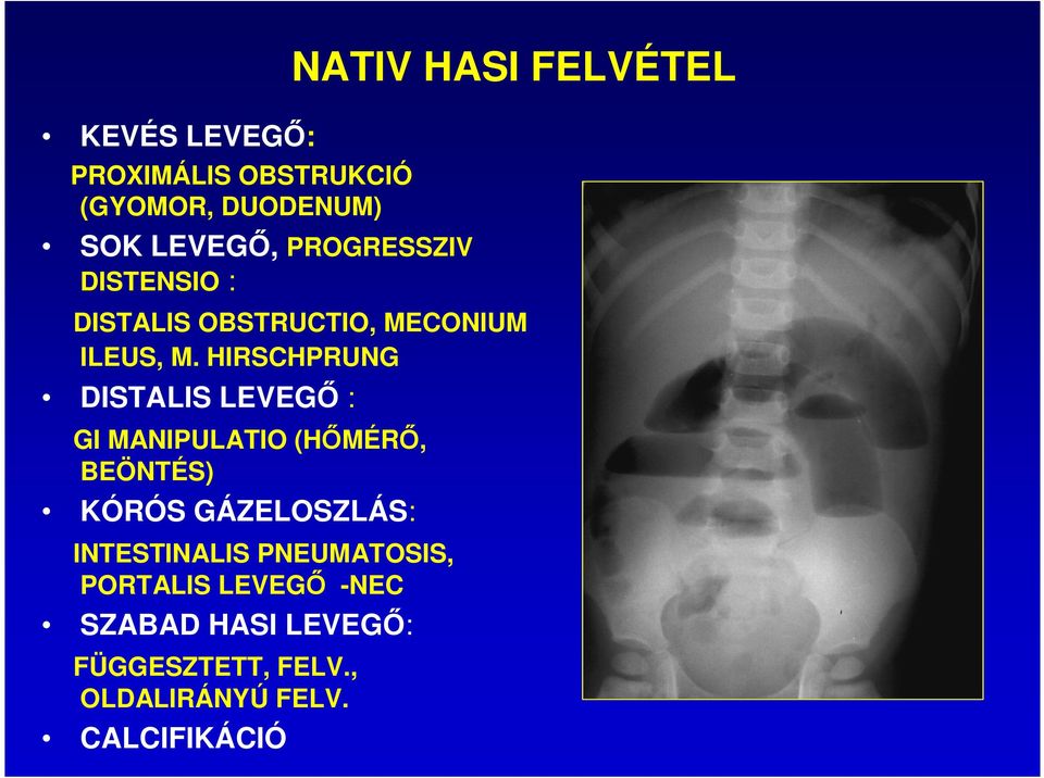 HIRSCHPRUNG DISTALIS LEVEGŐ : GI MANIPULATIO (HŐMÉRŐ, BEÖNTÉS) KÓRÓS GÁZELOSZLÁS: