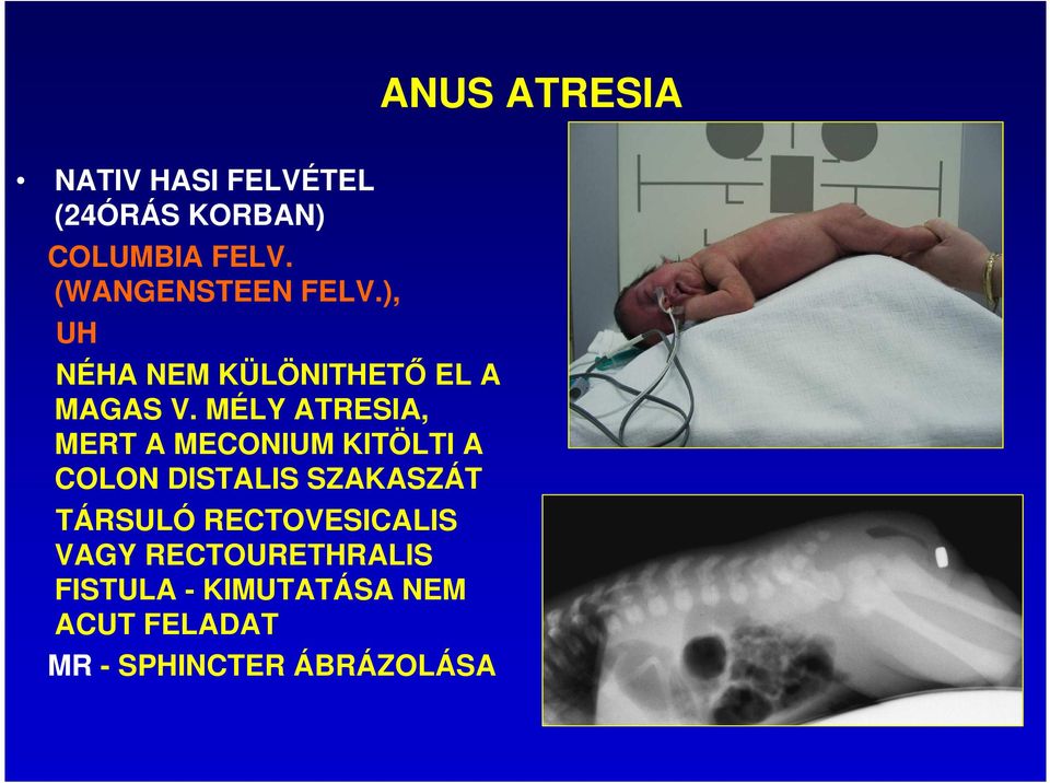 MÉLY ATRESIA, MERT A MECONIUM KITÖLTI A COLON DISTALIS SZAKASZÁT TÁRSULÓ