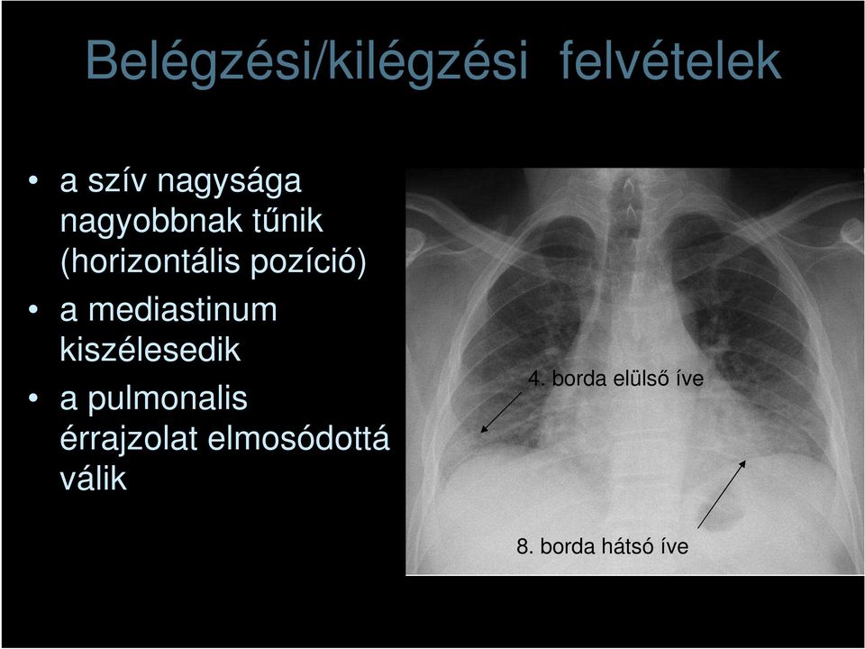 mediastinum kiszélesedik a pulmonalis érrajzolat