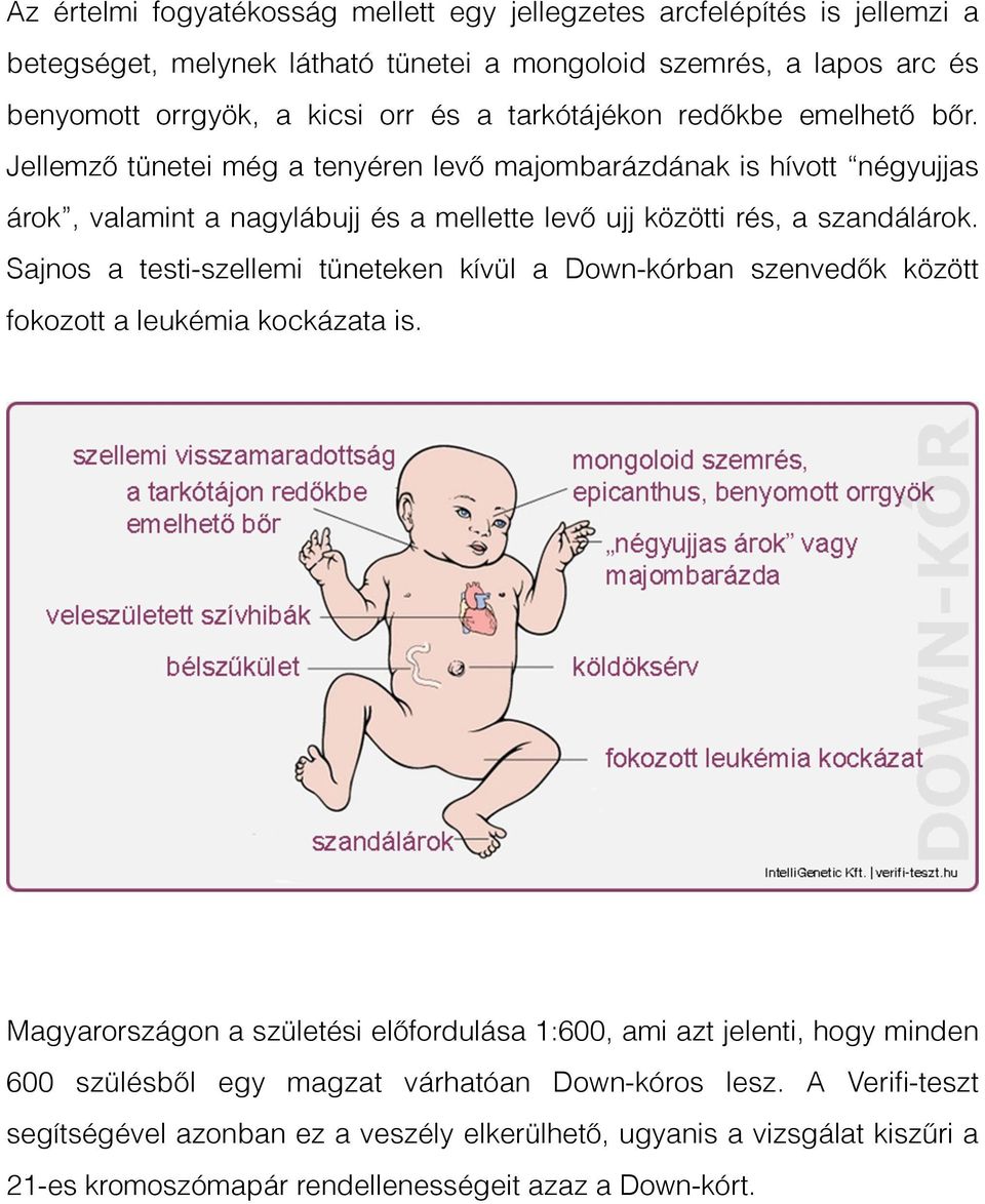 Sajnos a testi-szellemi tüneteken kívül a Down-kórban szenvedők között fokozott a leukémia kockázata is.