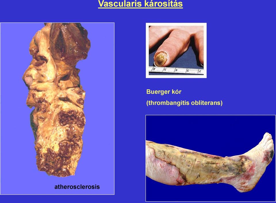 kór (thrombangitis