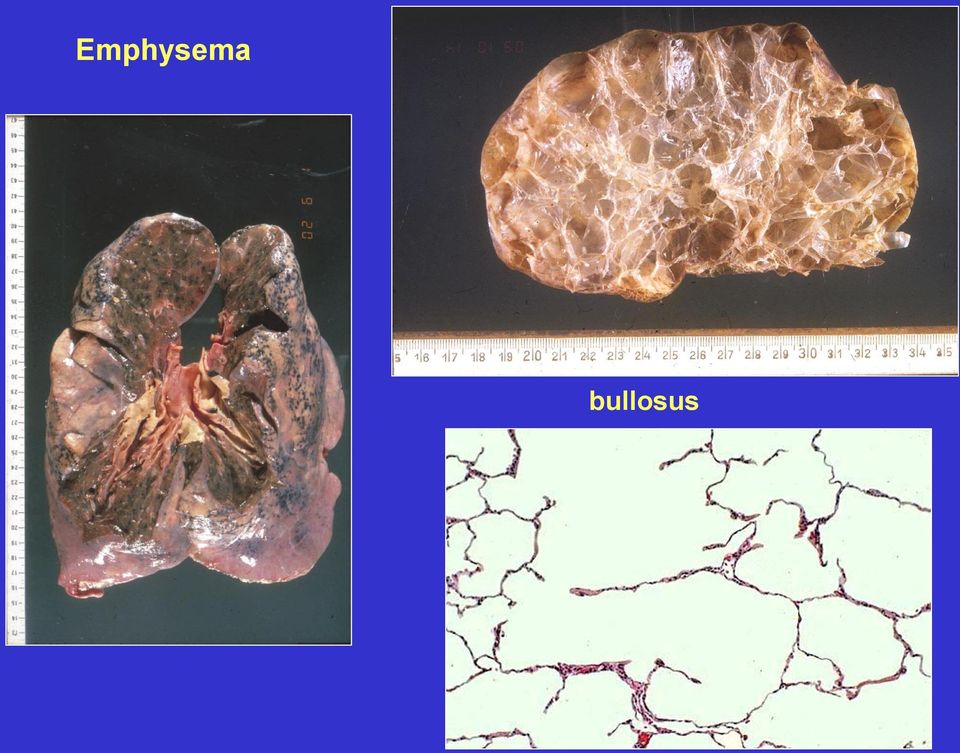 emphysema