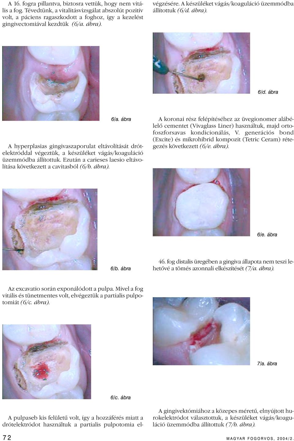 ábra 6/a. ábra A hyperplasias gingivaszaporulat eltávolítását drótelektróddal végeztük, a készüléket vágás/koaguláció üzemmódba állítottuk.