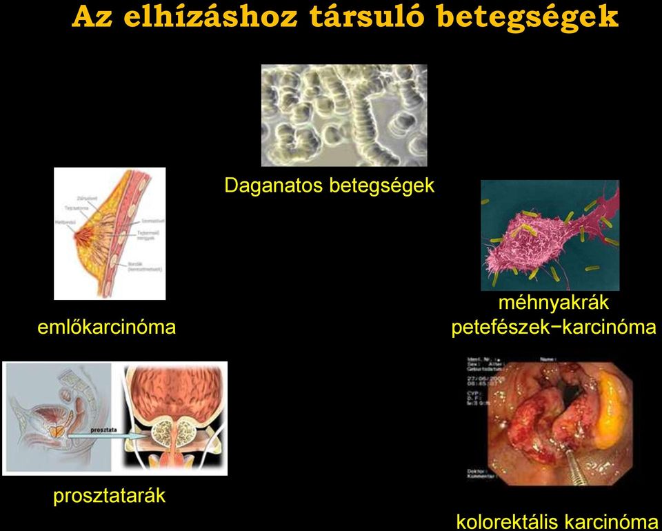 emlőkarcinóma méhnyakrák