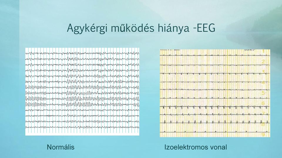 -EEG Normális