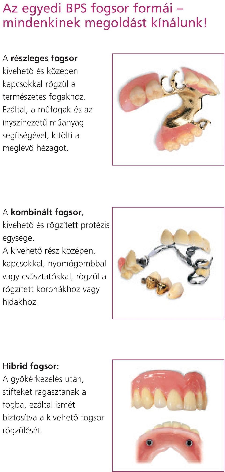 Ezáltal, a mıfogak és az ínyszínezetı mıanyag segítségével, kitölti a meglévœ hézagot.