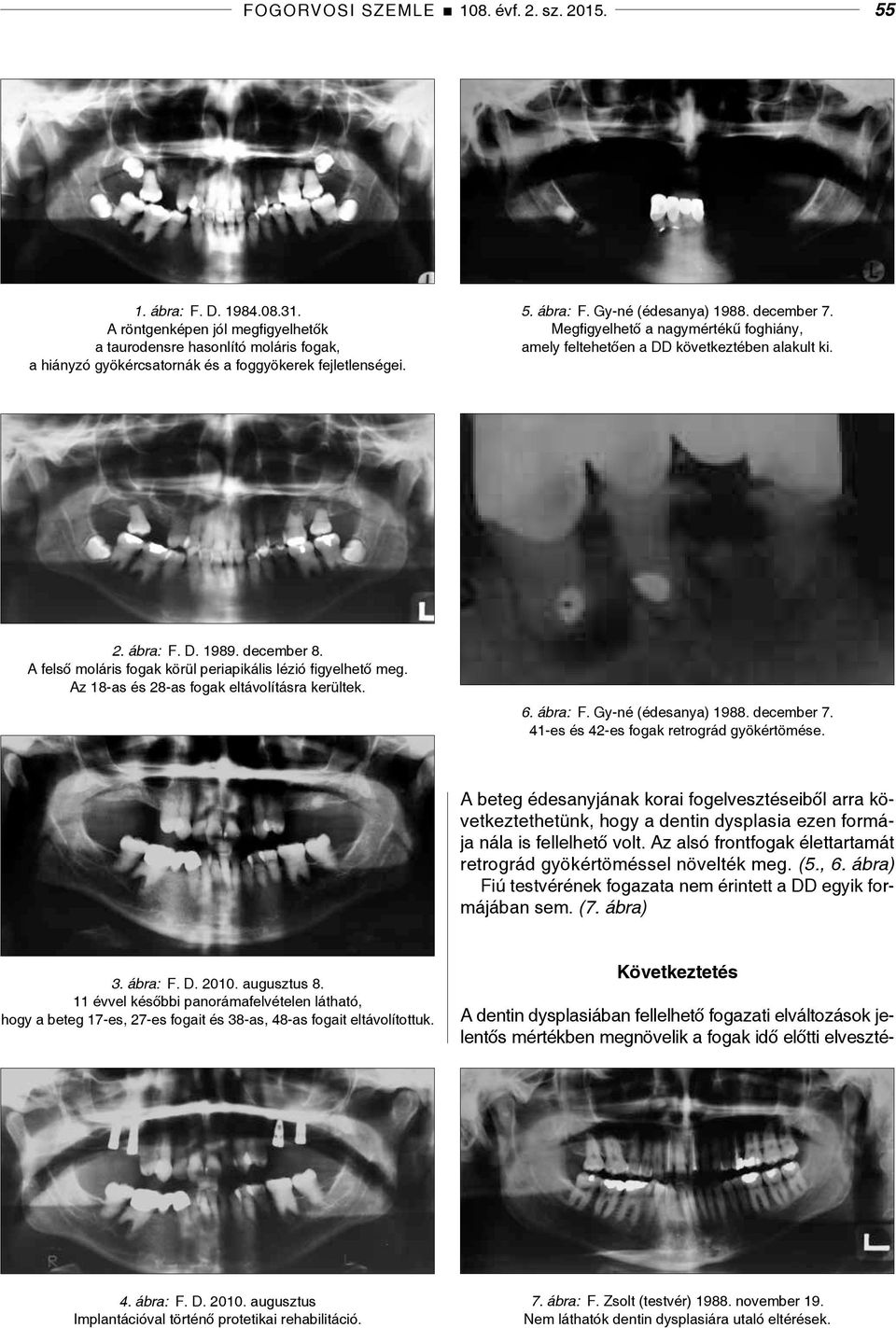 Megfigyelhető a nagymértékű foghiány, amely feltehetően a DD következtében alakult ki. 2. ábra: F. D. 1989. december 8. A felső moláris fogak körül periapikális lézió figyelhető meg.