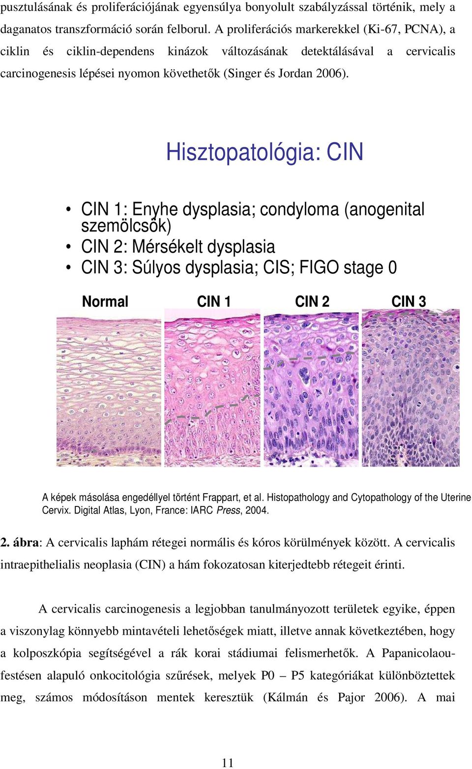 Hisztopatológia: CIN CIN 1: Enyhe dysplasia; condyloma (anogenital szemölcsök) CIN 2: Mérsékelt dysplasia CIN 3: Súlyos dysplasia; CIS; FIGO stage 0 Normal CIN 1 CIN 2 CIN 3 A képek másolása